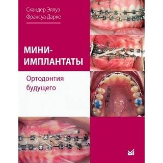 Мини-имплантаты. Ортодонтия будущего. Скандер Эллуз, Франсуа Дарке 2021 г. (МЕДпресс)